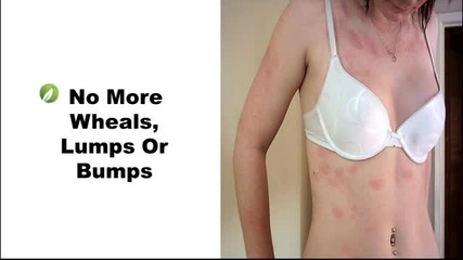 Allergic Reaction Hives