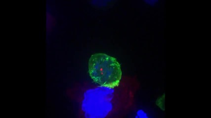 Т-килър лимфоцит напада ракова клетка