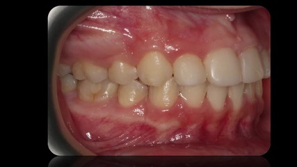 Още една красива усмивка след цялостно ортодонтско лечение с брекети.