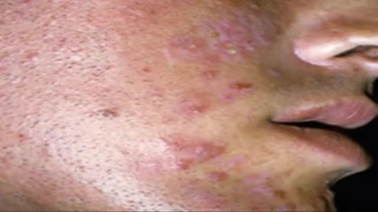 Como Quitar Acne Cara