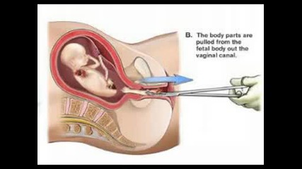 илюстрация на аборта