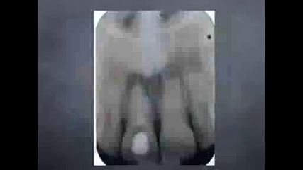 2009 Endodontic Course Pt4 - Obturation