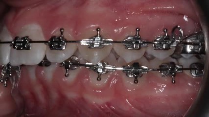 Един по-красив профил чрез ортодонтско лечение