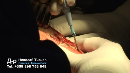 Д-р Николай Тивчев оперира пациент с травма на тазобедрената става