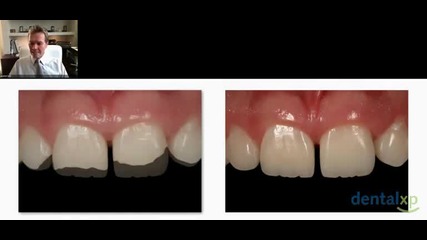 Selecting the right composite