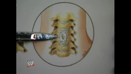 John Cena - Neck Surgery Part 2