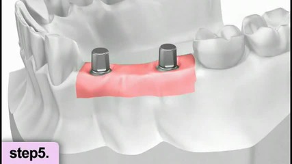 Dental implants procedure video - restoration 