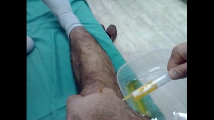 пункция на коляно