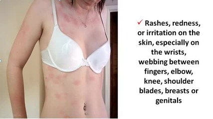 Remove Scabies Itchy Skin Condition