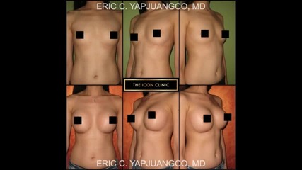 Breast Augmentation - Theiconclinic