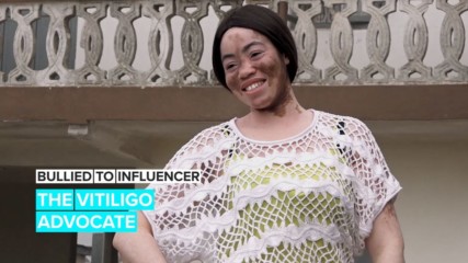 Bullied to Influencer: 'I’ve never tried to mask my vitiligo'