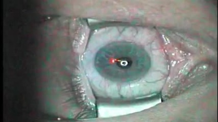 Как лазерна операция възвръща зрението веднага ! 
