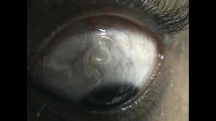 Ocular Loiasis - Филариоза (+18)