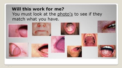 Angular Cheilitis Foundation | Natural Angular Cheilitis Treatment. How does the treatment work? 
