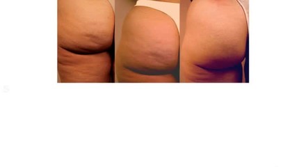 Cellulite Rimedi Naturali