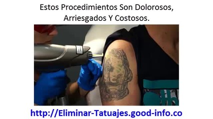 Como Eliminar Un Tatuaje, Como Borrar Tatuajes Permanentes, Cuanto Cuesta Borrarse Un Tatuaje