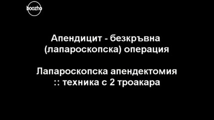 безкръвна операция на Апандисит