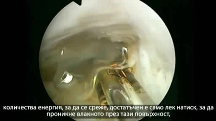 Операция на простата със Зелен лазер, извършена от проф. д-р Фернандо Санча