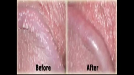 How to Remove Pearly Penile Papules at Home Pearly Penile Papules Glans