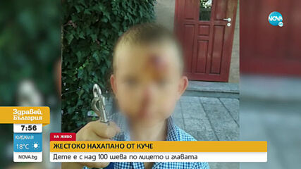 Детето, нахапано от куче край Пловдив, се хранило със сламка 20 дни