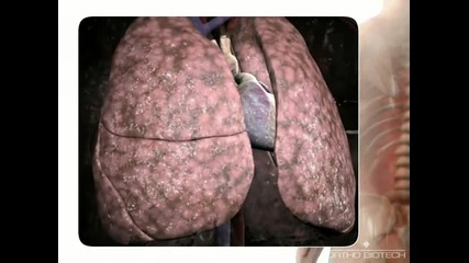 Congestive Heart Failure Animation