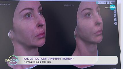 Как се поставят лифтинг конци? - „На кафе” (07.07.2023)
