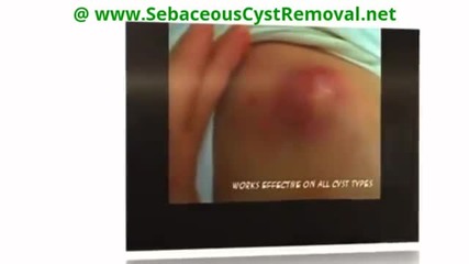 Sebaceous Cyst Removal Treatment; 100% Natural Remedy Cure!
