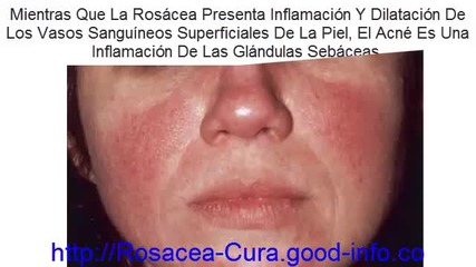 Rosacea Tratamiento Natural, Rosacea Ipl, Pitiriasis Rosacea, Tratamiento Para La Rosacea Facial