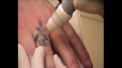 Премахване На Tattoo