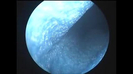 Лазерно разбиване на камък в мехура в Хил клиник