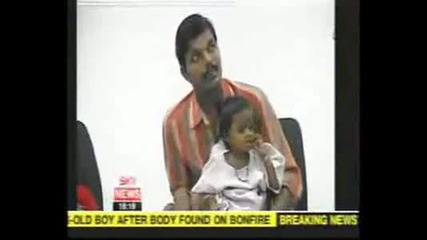Дете От Индия Родено С 8 Крайника 