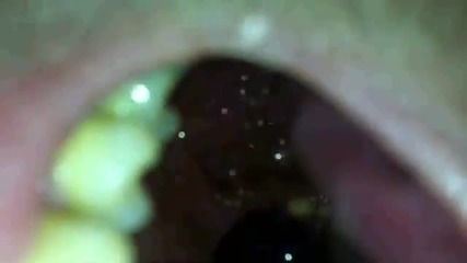 Get Rid Of Your Tonsil Stones tonsilloliths