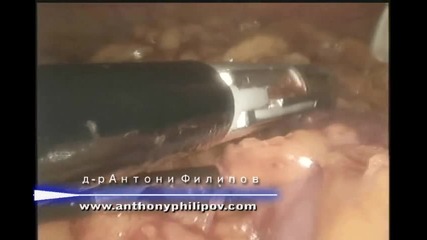 Лапароскопска операция на липом