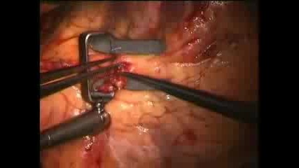 Операция на биещо сърце - off pump coronary artery surgery