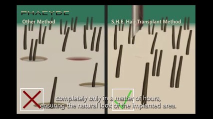 Hair Implant with the S.h.e. Hair Implant Method - Phaeyde Clinic