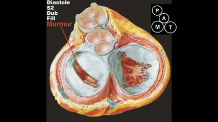 Митрална стеноза - Animated Mitral Stenosis Murmur