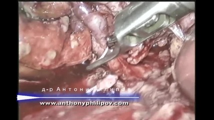 Лапароскопска холецистекомия (лапароскопска операция на жлъчка)