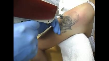 tattoo премахване на татус с лазер София