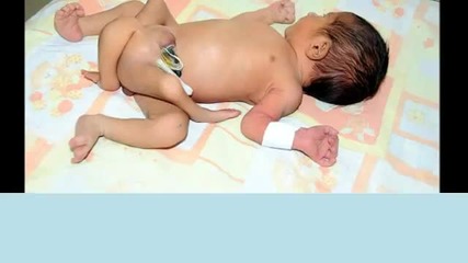 Лекари от Пакистан ще оперират бебето с 6 крака !!!!!!!!