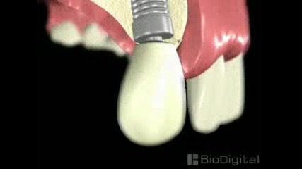 Имплантиране на зъб