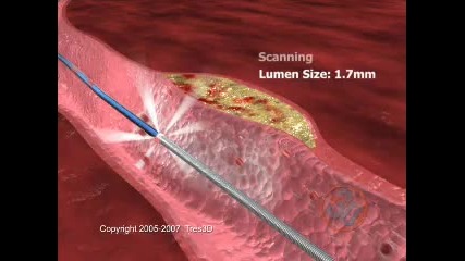 Medical Animation - Stent Procedure how a stent is used