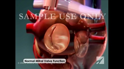 Митрална регургитация - Mitral Valve Regurgitation