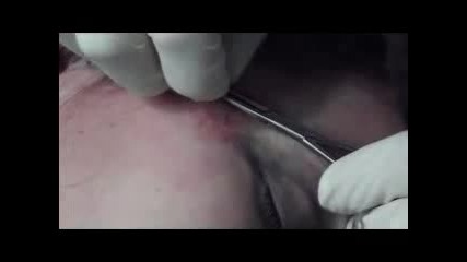 Microdermal (Piercing) Procedure