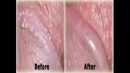 Ppp Clinic, Get Rid Of Papules, Ppp Removal Cream, Papule Treatment, Little White Bumps