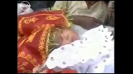Бебе С Две Лица Се Роди В Индия