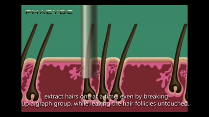 Hair Implant with the S.h.e. Hair Implant Method - Phaeyde Clinic (part 1/3)