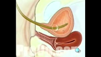 eop® Patient Education Cystoscopy via Vagina,  Female Surgery