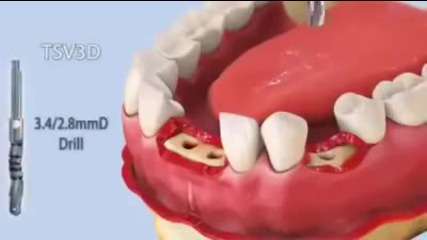 Как се слага зъбни протези на винт