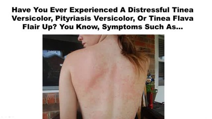 Tinea Versicolor Treatment