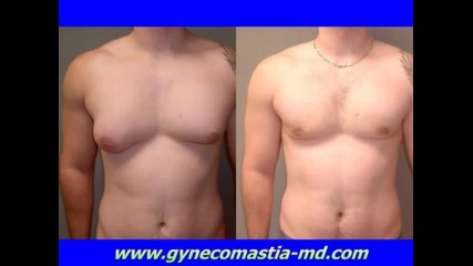 Гинекомастия - мъж с женски гърди 